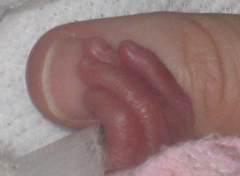micro preemie finger